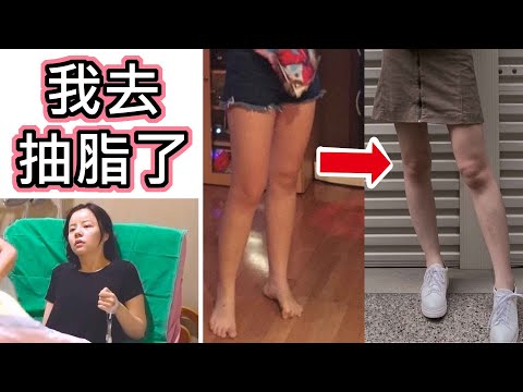 【我去抽脂了！】大腿環抽+腹部背部抽脂，手術過程分享｜超直白Chaozhibai